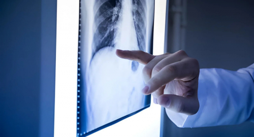 Tumore al polmone, nuova MRI individua lesioni sotto un millimetro